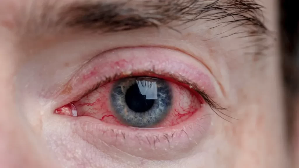 What is Commonly Misdiagnosed as Pink eye